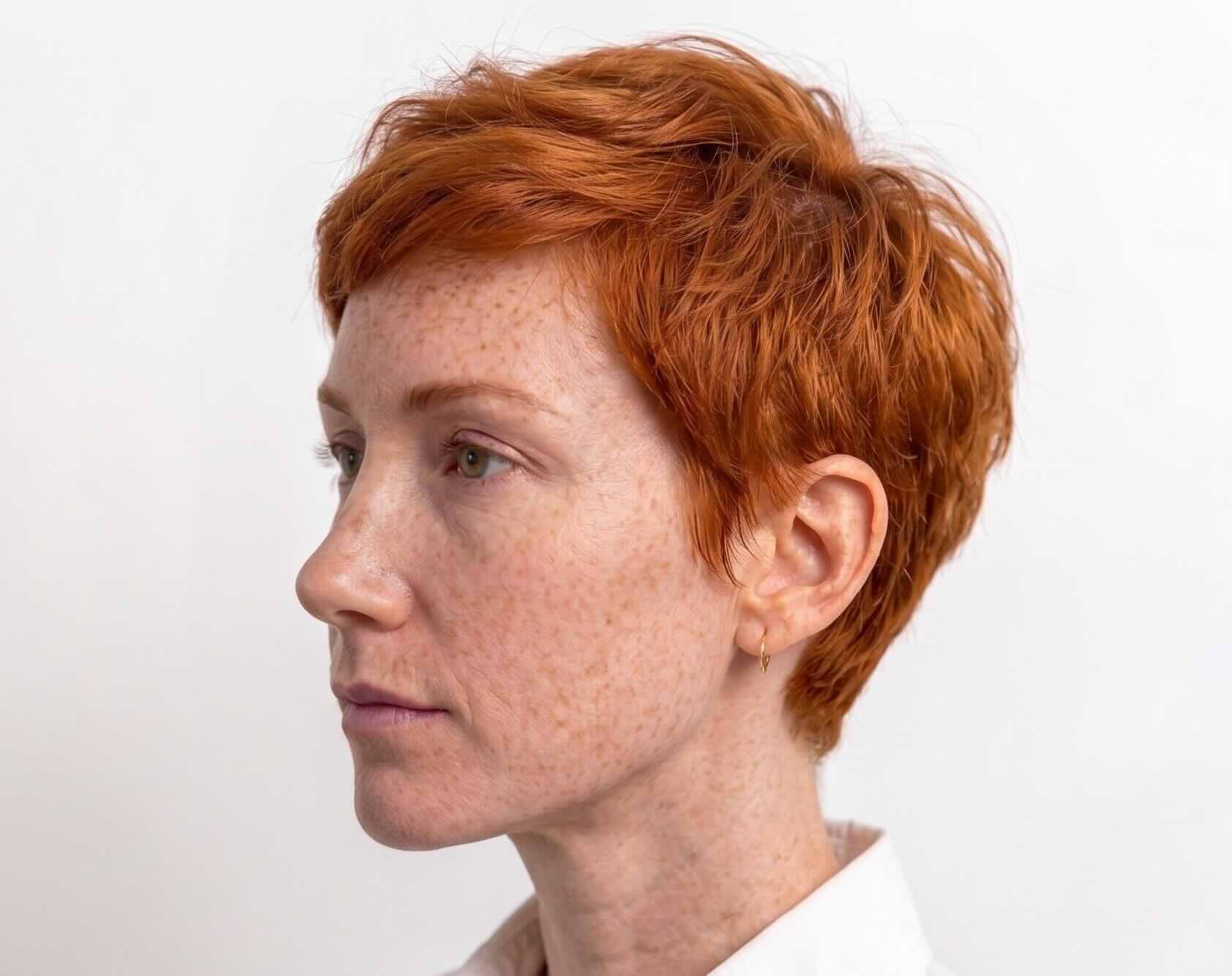 Avant — rhinoplastie homme